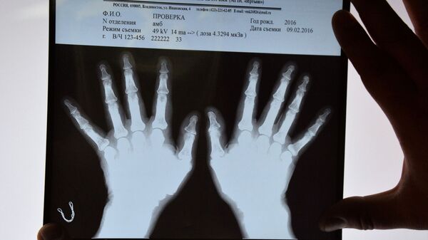 Рентгеновские снимки кистей рук. Архивное фото - Sputnik Южная Осетия
