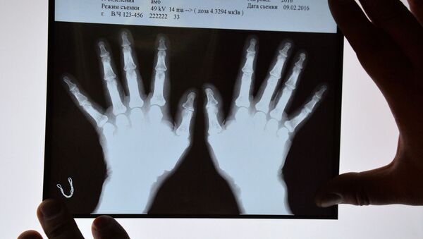 Рентгеновские снимки кистей рук. Архивное фото - Sputnik Южная Осетия