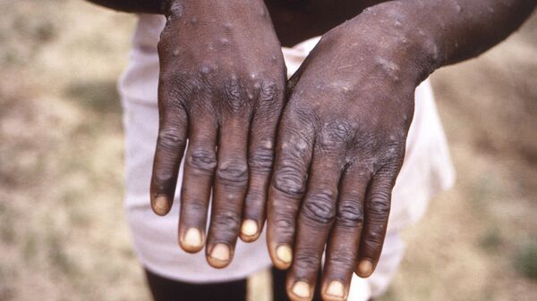 Оспа обезьян MPOX - Sputnik Южная Осетия