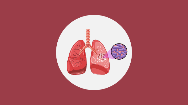 Хуссар Иры туберкулезæй рынчынкæнынады статистикæ - Sputnik Хуссар Ирыстон