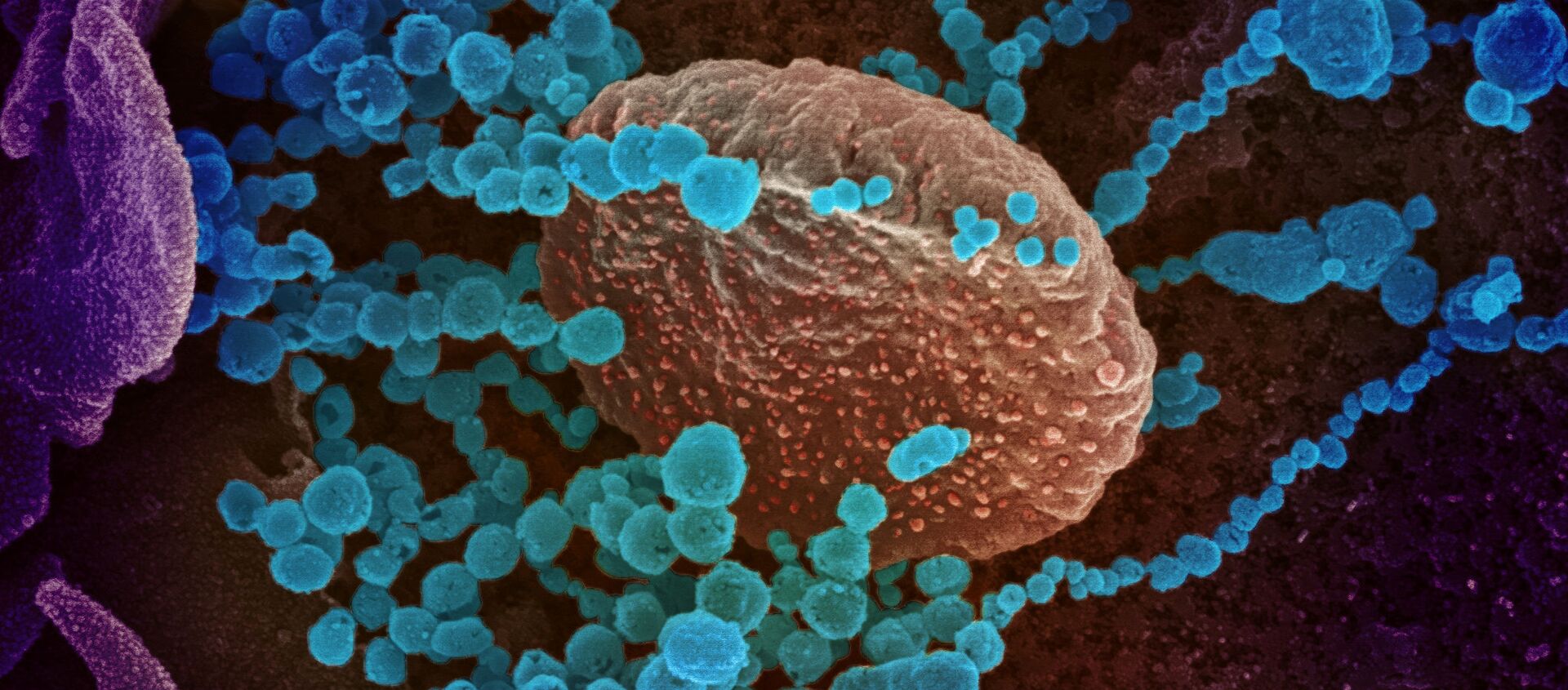 Вид на зараженную коронавирусом  клетку под микроскопом  - Sputnik Южная Осетия, 1920, 30.06.2021