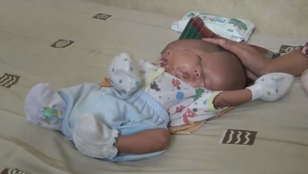 Ребенок в Индонезии родился с двумя лицами - Sputnik Южная Осетия