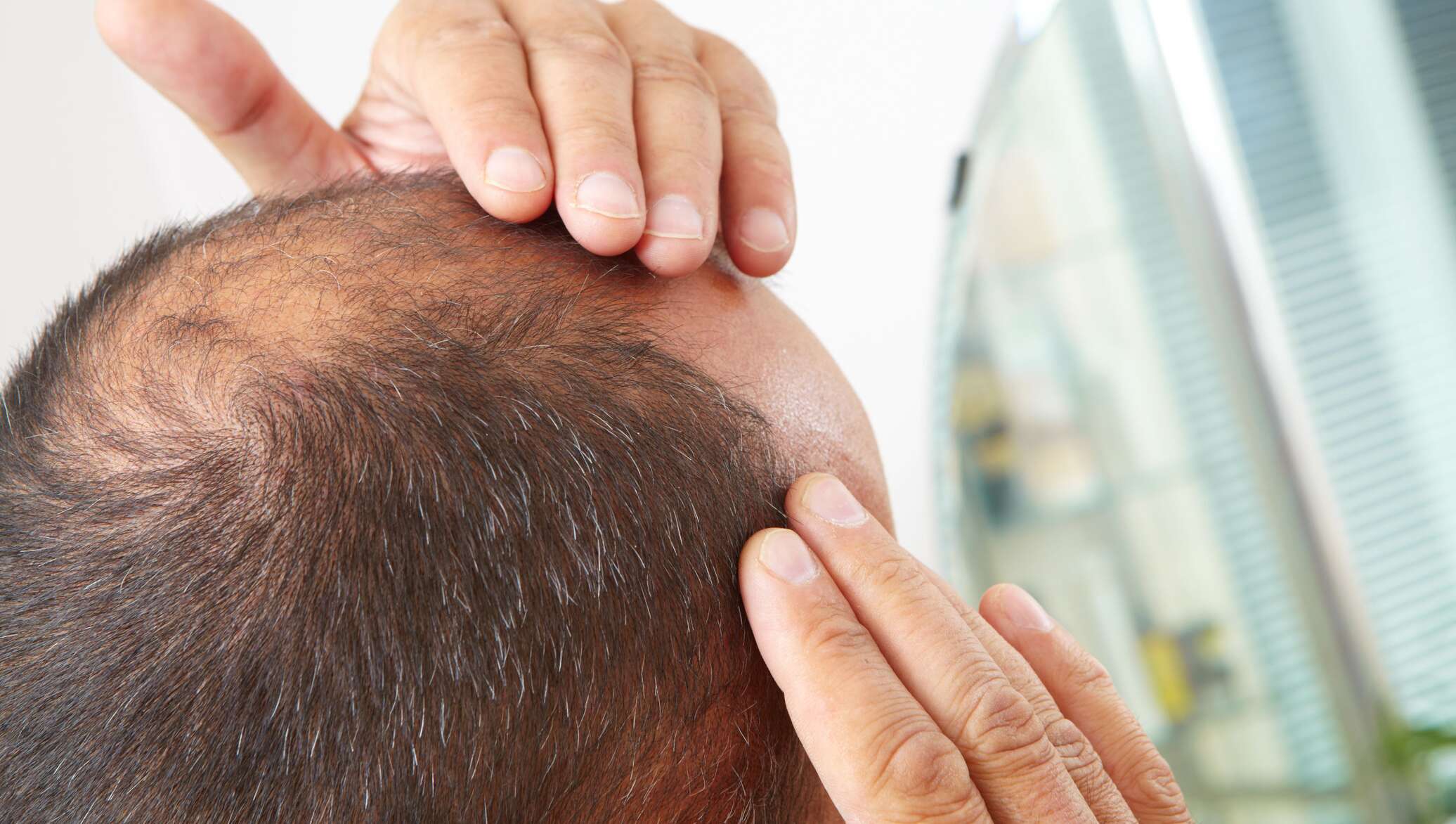 Как предотвратить выпадение волос у мужчин народными средствами