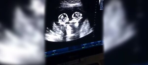 Близнецы на УЗИ - Sputnik Южная Осетия