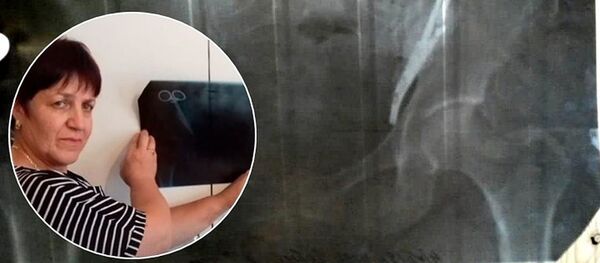 В Северной Осетии женщина 23 года мучилась от адской боли из-за забытых в животе хирургических зажимов В Северной Осетии женщина 23 года мучилась от адской боли из-за забытых в животе хирургических зажимов - Sputnik Южная Осетия